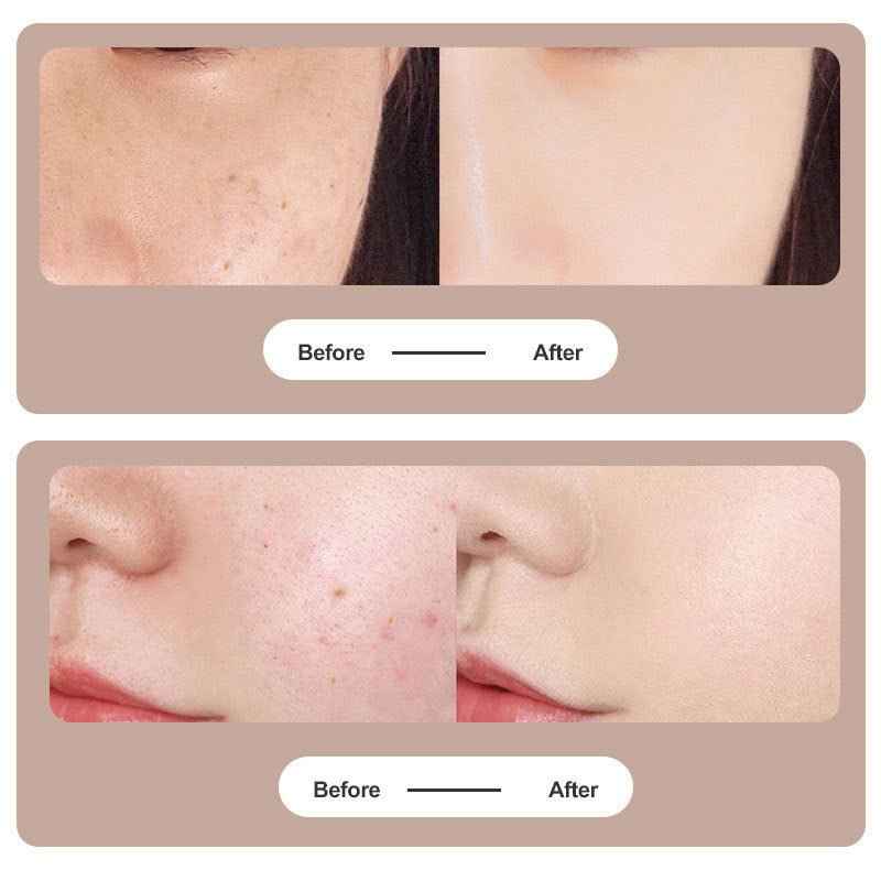 Laser Facial Skin Tag Remover Fibroderma